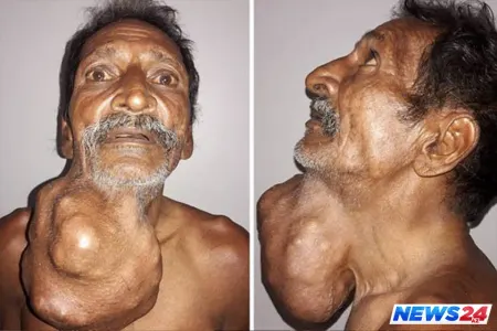 Həkimlər xəstənin boğazından başı boyda şiş çıxardılar