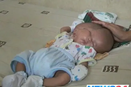 İndoneziyada iki üzlü körpə doğulub - FOTO/VİDEO