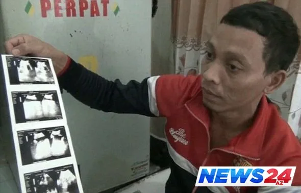 İndoneziyada iki üzlü körpə doğulub - FOTO/VİDEO