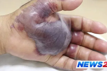 Sevdiyi yemək əlinin kəsilməsinə səbəb oldu - VİDEO