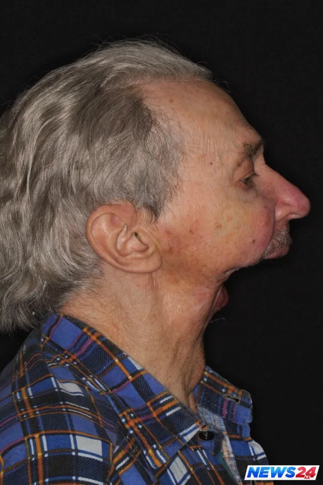 Üzünün yarısı olmayan insan necə həyatda qaldı?