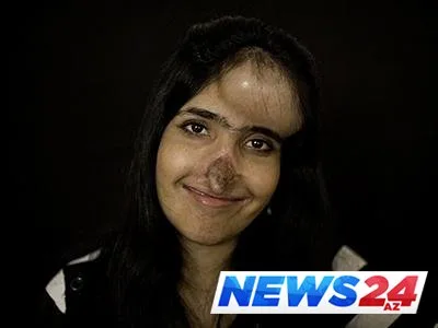 Üzünün yarısı olmayan insan necə həyatda qaldı?