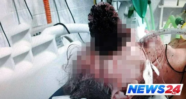 Hamamda ayağı sürüşdü, unitaz fırçası gözünə girdi və... - FOTO