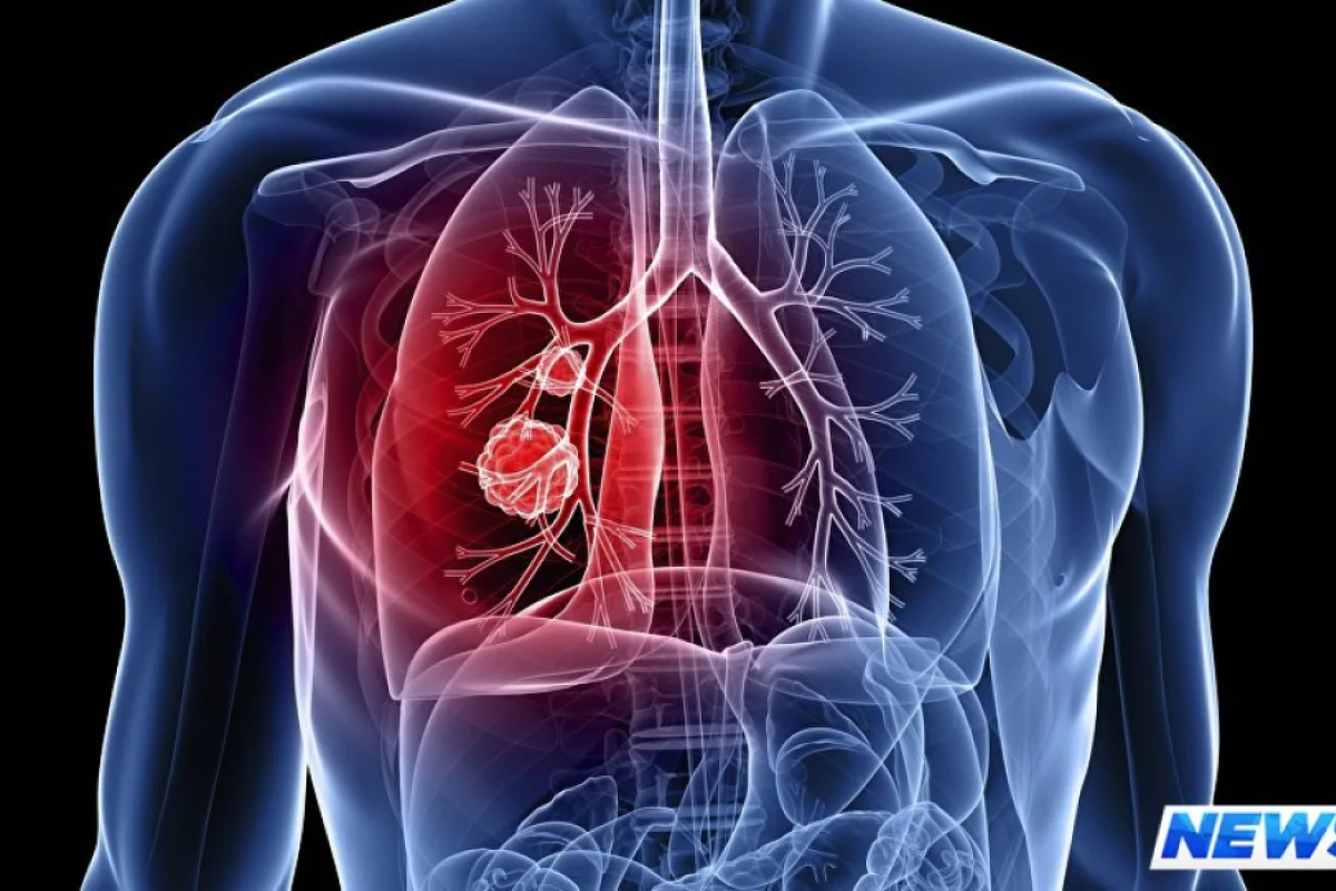 Xərçəng xəstələri artır, yoxsa bizə elə gəlir?