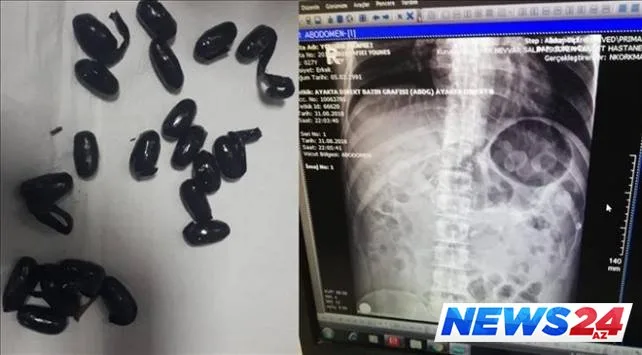 Mədəsindən 198 qram narkotik maddə çıxdı