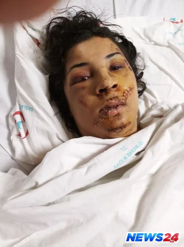 Boşandığı arvadının üzünü şüşə ilə kəsdi