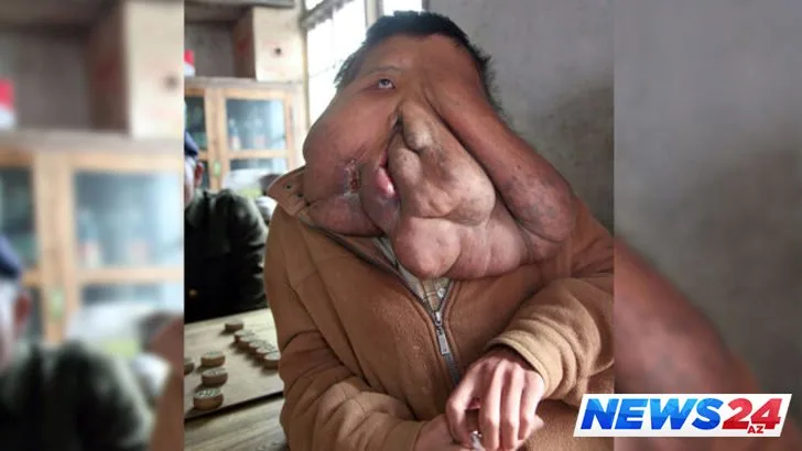 Üzündə 15 kiloluq şişlə gəzən adam-FOTO