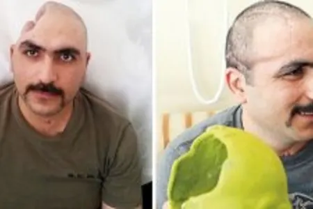 Aprel döyüşlərində yaralanan hərbçiyə Türkiyədə süni kəllə qapağı qoyuldu