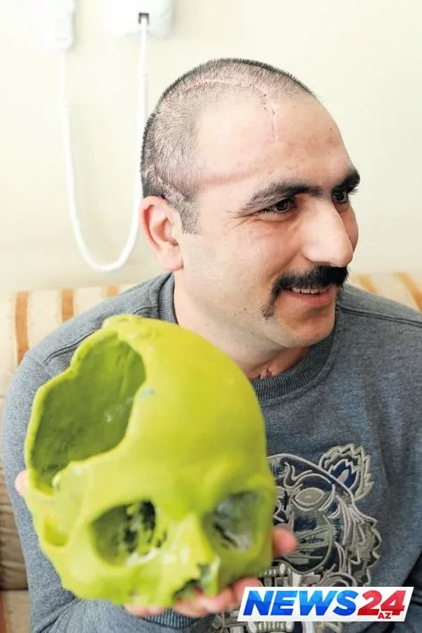 Aprel döyüşlərində yaralanan hərbçiyə Türkiyədə süni kəllə qapağı qoyuldu