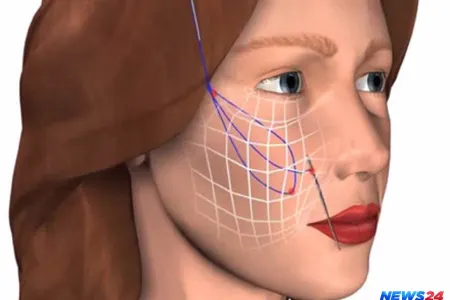 Qızıl saplarla dərinin cavanlaşdırılması - VİDEO