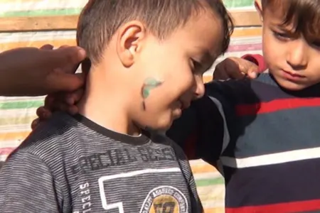 Lənkəranda 4 yaşlı uşaq çaqqal hücumuna məruz qalıb - FOTO