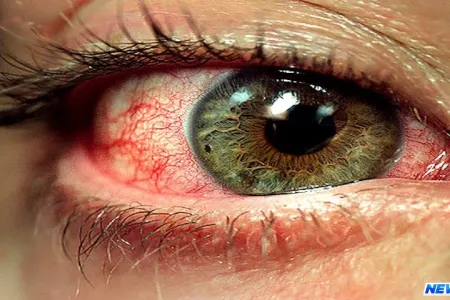 Gözləriniz səbəbsiz yerə qızarır, burnunuzdan su gəlirsə… - Gözə yansıyan gizli xəstəliyiniz var...