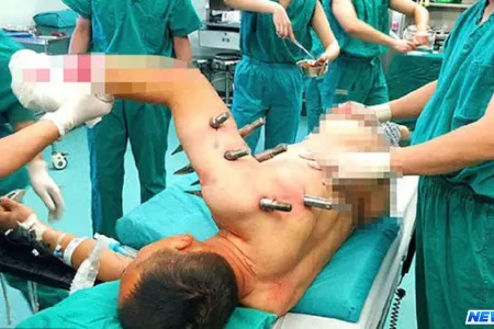 DƏHŞƏTLİ QƏZA - Dəmir şişlər bir anda işçinin bədəninə batdı - FOTO