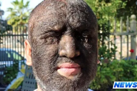 Dünyanın ən tüklü adamı: “Özümlə qürur duyuram” – FOTO