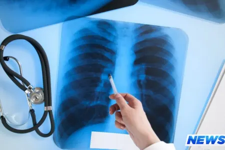 ÜST: Ötən il dünyada 1,3 milyon insan vərəmdən ölüb