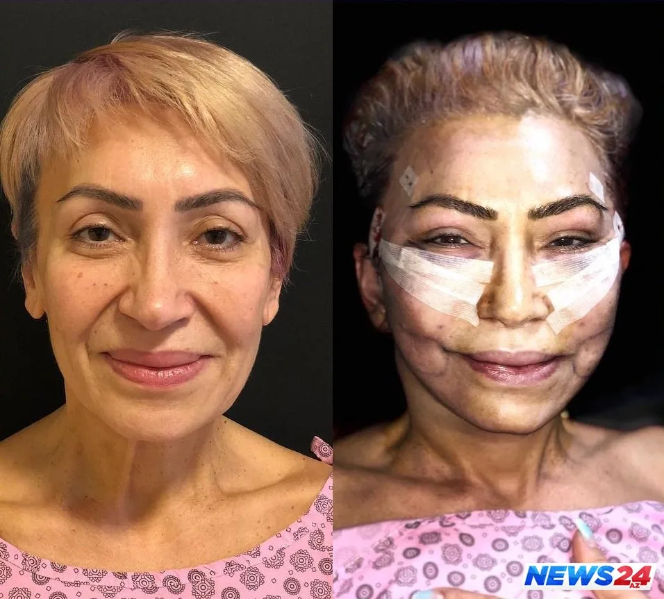 Plastik əməliyyat etdirən 57 yaşlı əməkdar artistin son görüntüsü - FOTOLAR