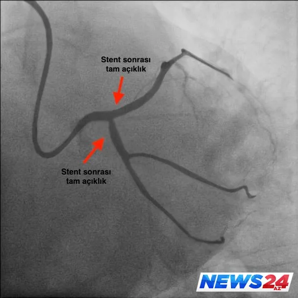 “EGE Hospital”-da daha bir uğurlu əməliyyat - FOTOLAR