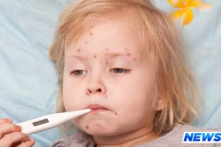 Nazirlikdən qızılca açıqlaması - Əhali peyvəndlənəcək