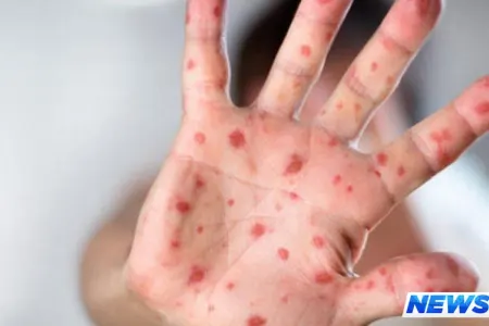 Azərbaycanda 55 nəfər qızılcaya yoluxub, əhaliyə pulsuz vaksin vurulacaq