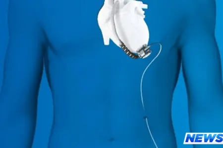 Azərbaycanda inanılmaz əməliyyat - Xəstəyə süni ürək köçürüldü - FOTO