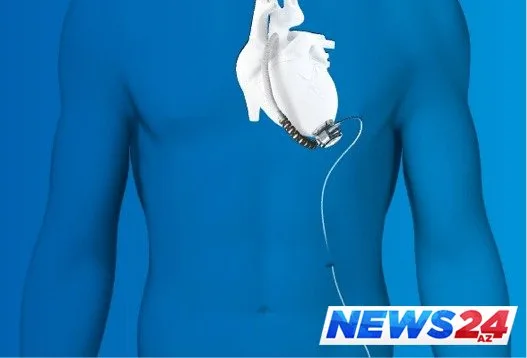 Azərbaycanda inanılmaz əməliyyat - Xəstəyə süni ürək köçürüldü - FOTO