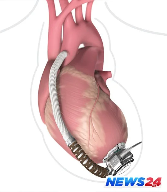 Azərbaycanda inanılmaz əməliyyat - Xəstəyə süni ürək köçürüldü - FOTO