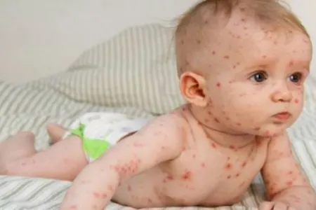 Qızılca bəzi ölkələrdə 4 dəfə artaraq epidemiya halını alıb - SOS