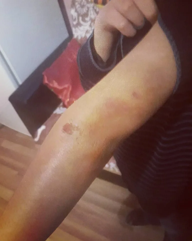 Anası tərəfindən vəhşicəsinə döyülən uşaqdan xəbər var- - "qolu və ayaqları..."