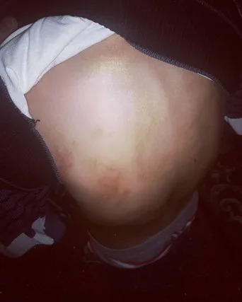 Anası tərəfindən vəhşicəsinə döyülən uşaqdan xəbər var- - "qolu və ayaqları..."