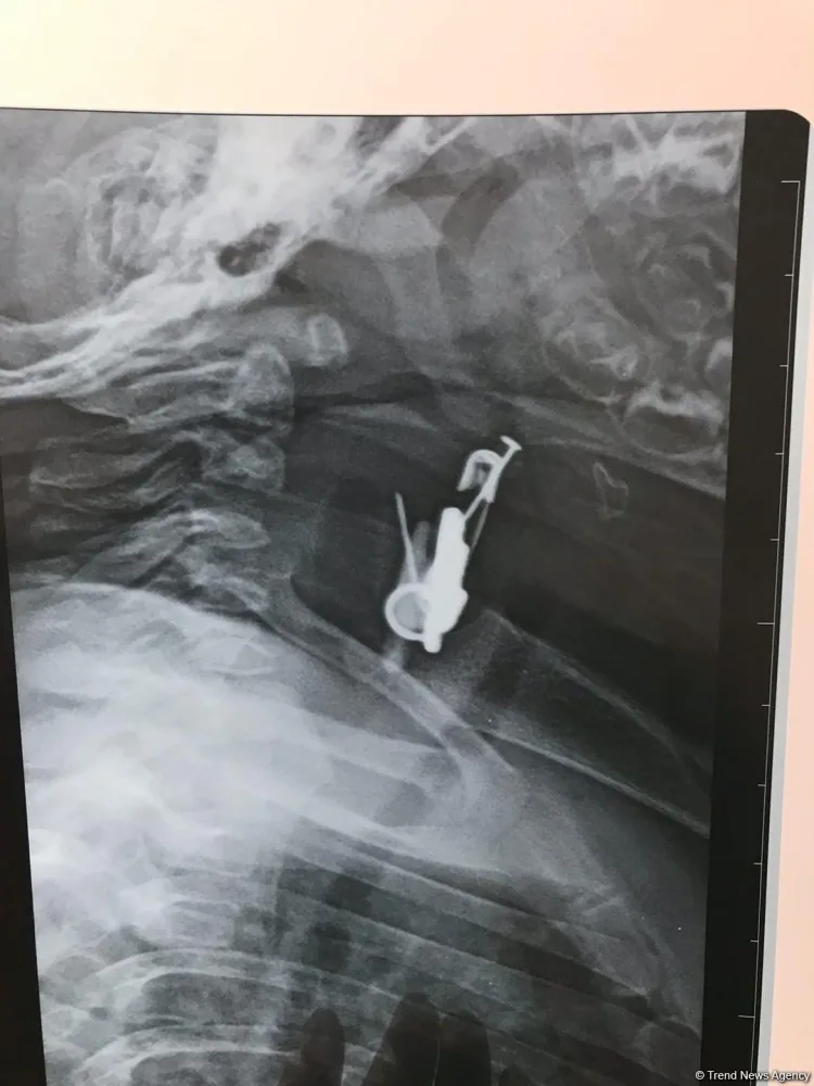 Nəzərdən qorumaq istədilər, amma... - Körpənin mədəsindən bunlar çıxdı - FOTO