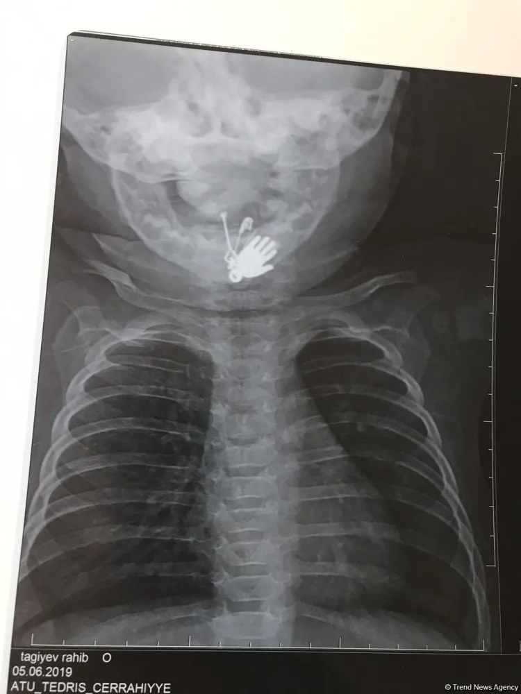 Nəzərdən qorumaq istədilər, amma... - Körpənin mədəsindən bunlar çıxdı - FOTO