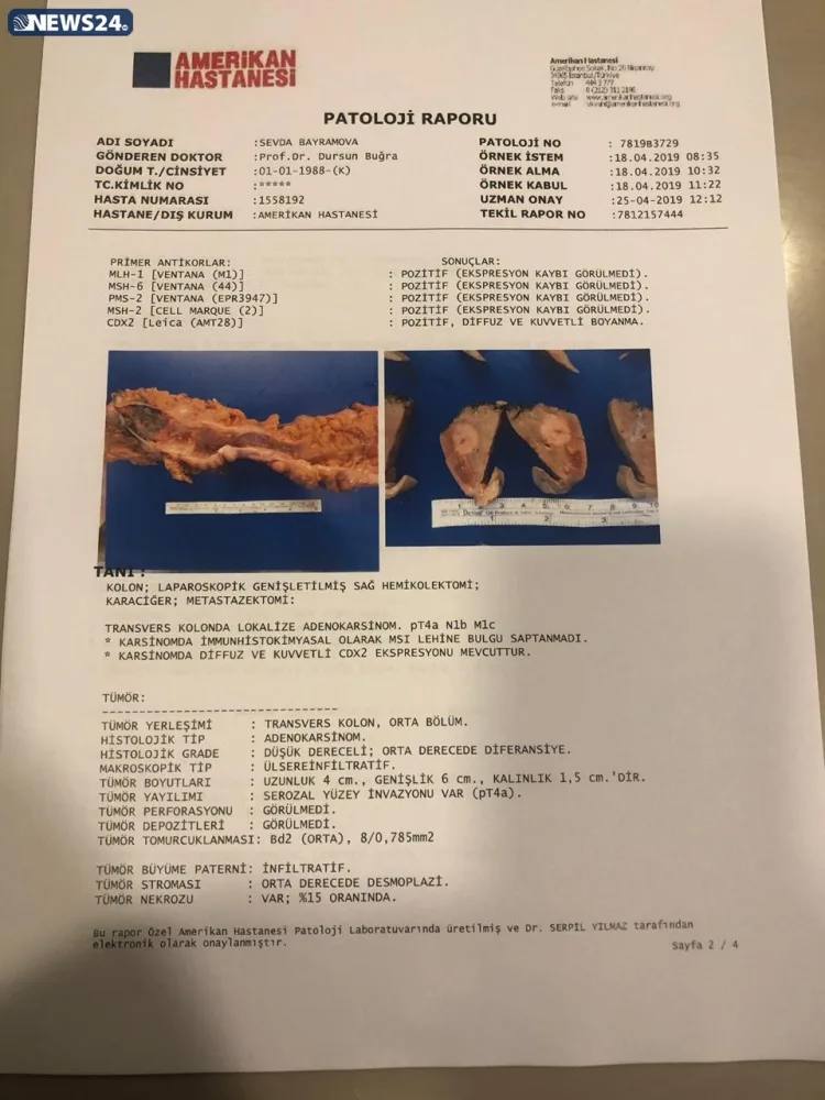 "Mənə düzgün diaqnoz qoyulsaydı, metastaz verməyəcəkdi"- - Tədris Cərrahiyyə Klinikasında QALMAQAL