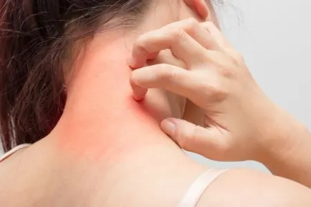 Allergiyanın əmələ gəlmə səbəbləri - xəstələrin sayında kəskin artım var