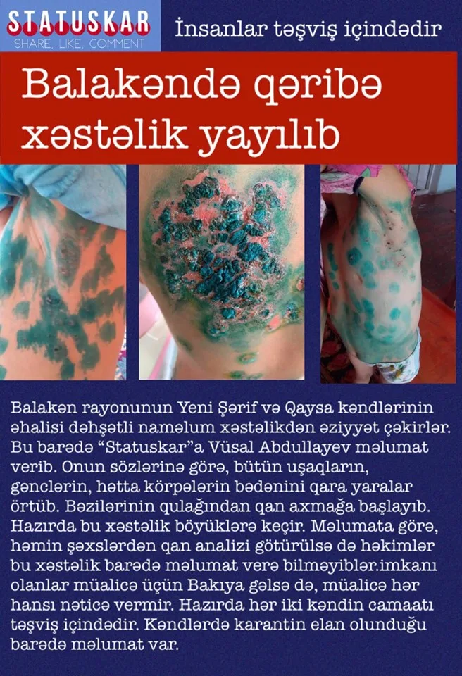 Balakəndə naməlum xəstəlik yayılıb? - RƏSMİ AÇIQLAMA-FOTO