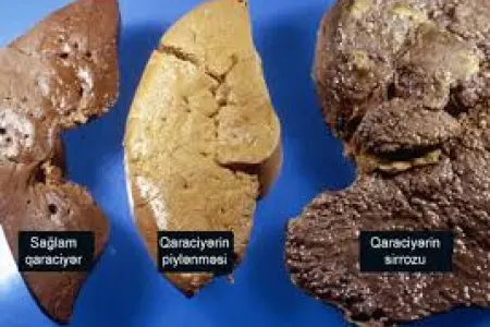 Qaraciyəri piyləndirən səbəblər hansılardır?