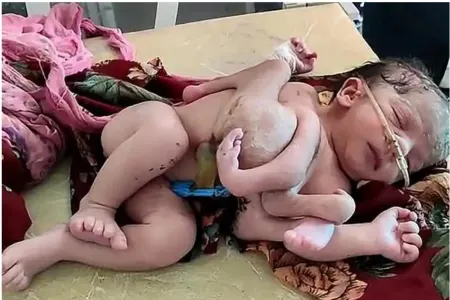 3 qolu, 4 ayağı olan uşaq doğuldu