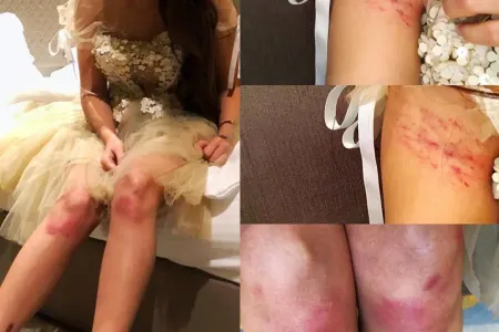 Məşhur aparıcı çəkiliş zamanı ciddi xəsarət aldı - ŞOK - FOTO