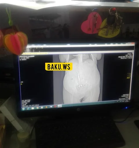 Azərbaycanda əməliyyatda qadının bədənində qayçı qalıbmış - FOTOLAR