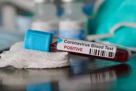 Gürcüstanda koronavirusa yoluxanların sayı 83 nəfərə çatdı