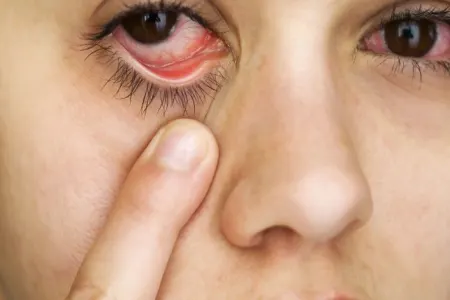 Koronavirusun yeni əlaməti - Konyunktivit