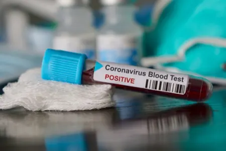 Bu gün 3656 nəfər test olundu- - KORONAVİRUSLA BAĞLI