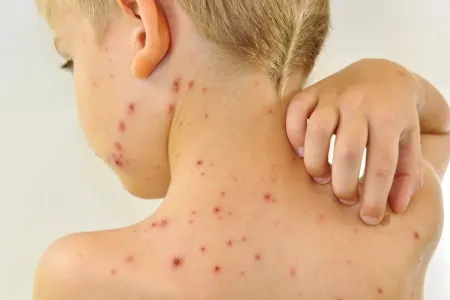 Qızılca və poliomielit epidemiyaları baş qaldıra bilər - ÜST