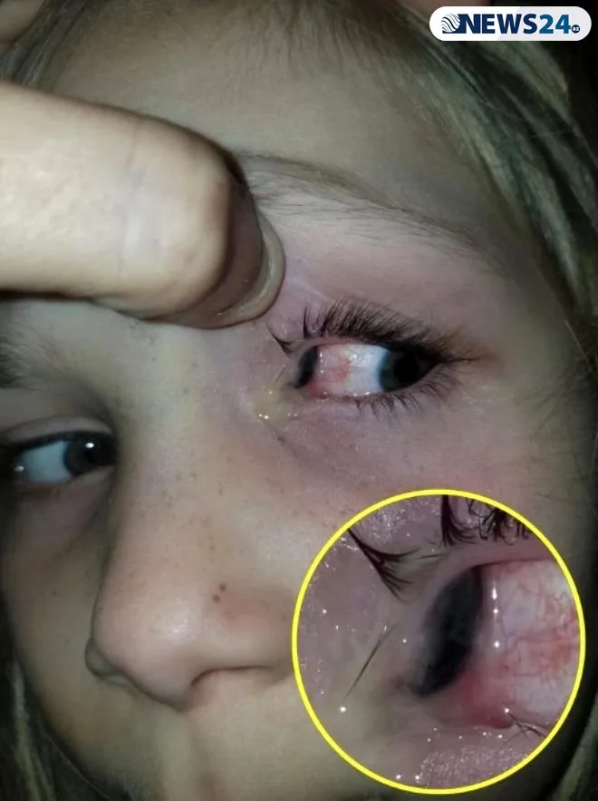 ŞOK! 6 yaşlı uşağın gözündən - BÖCƏK ÇIXDI - FOTOLAR