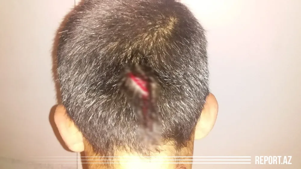 Ata dilənmək istəməyən 11 yaşlı oğlunu başından - BIÇAQLADI