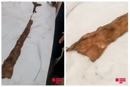 8 ay əvvəl əməliyyat olundu, həkim tamponu qarnında unutdu - Azərbaycanda olay - Video