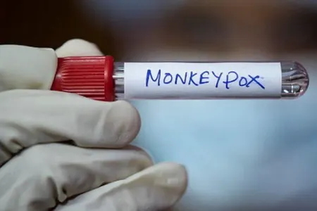 Moldovada meymunçiçəyinə ilk yoluxma qeydə alındı