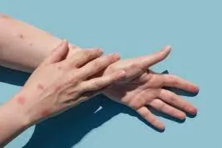İranda meymunçiçəyinə yoluxma qeydə alındı