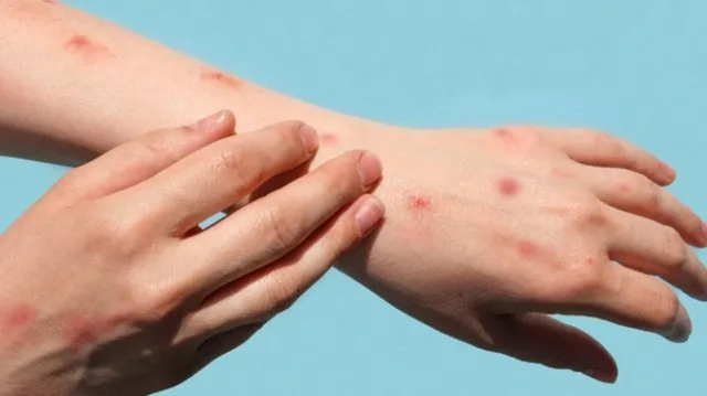 Daha bir virus təhlükəsi: 5 yaşadək uşaqlar yoluxur
