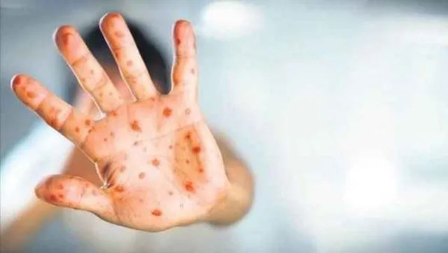 Daha bir virus təhlükəsi: 5 yaşadək uşaqlar yoluxur