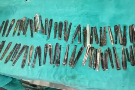 Xəstəxanaya gedən kişinin mədəsindən 63 qaşıq çıxarıldı